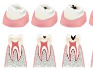 Лечение кариеса молочных зубов у детей раннего возраста — профилактика Почему у детей кариес на молочных зубах
